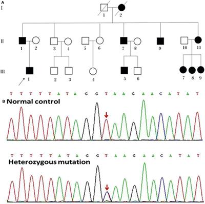 Cortical Damage Associated With Cognitive and Motor Impairment in Hereditary Spastic Paraplegia: Evidence of a Novel SPAST Mutation